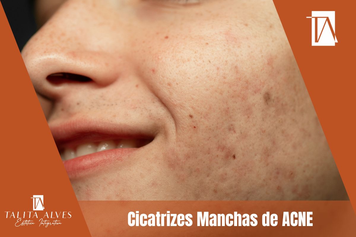 Cicatrizes Manchas de ACNE