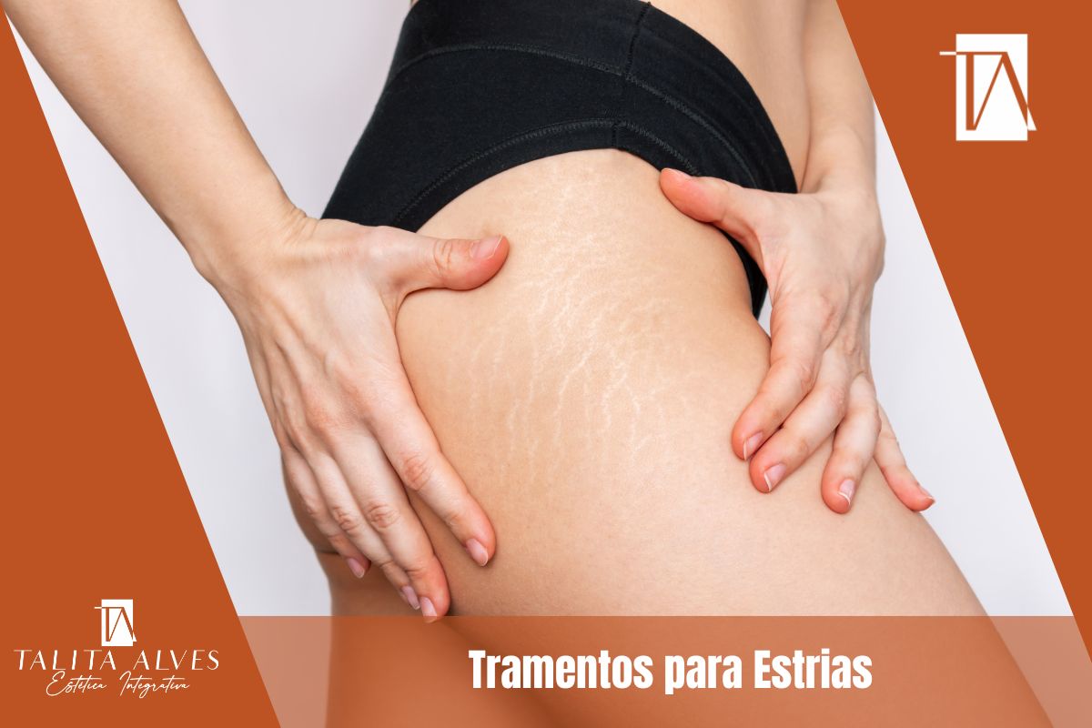 Tramentos para Estrias SP