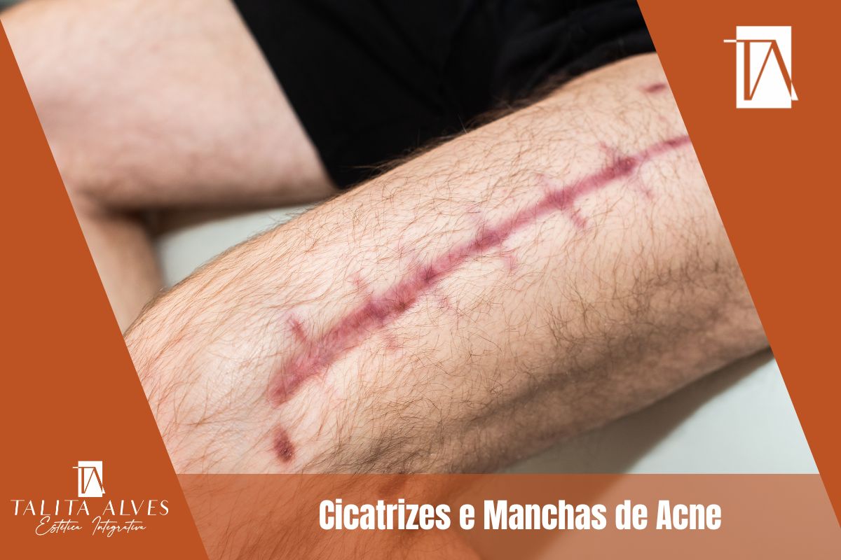 Tratamento Cicatrizes Manchas ao Lado do Metrô São Judas