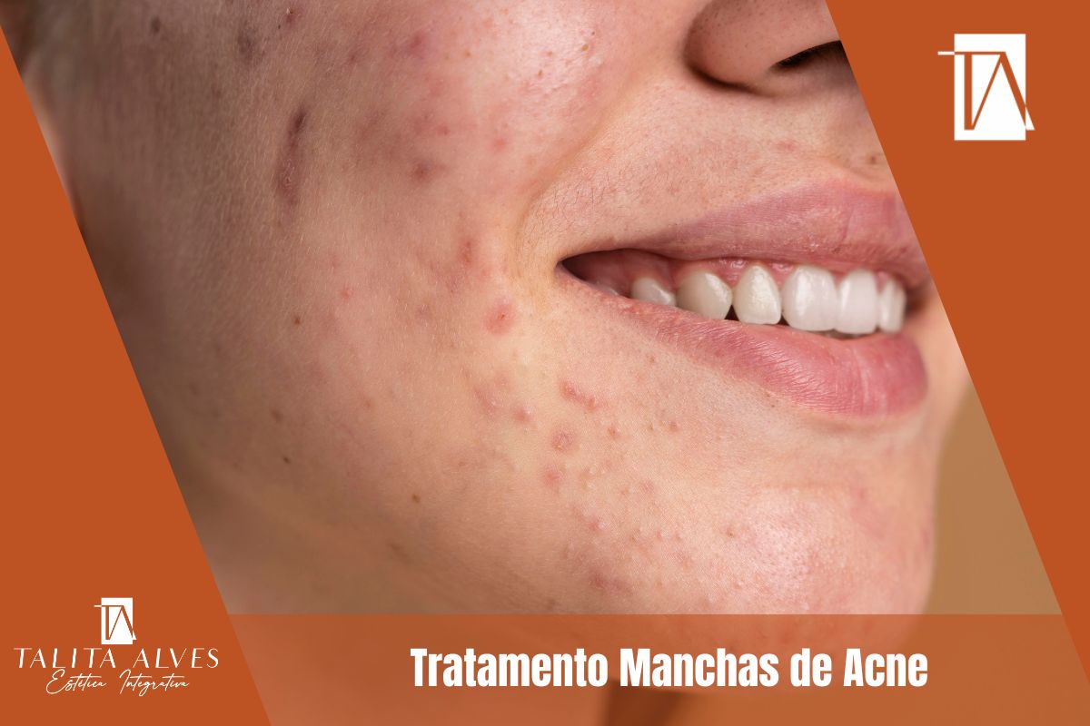 Tratamento Manchas de Acne ao Lado do Metrô São Judas