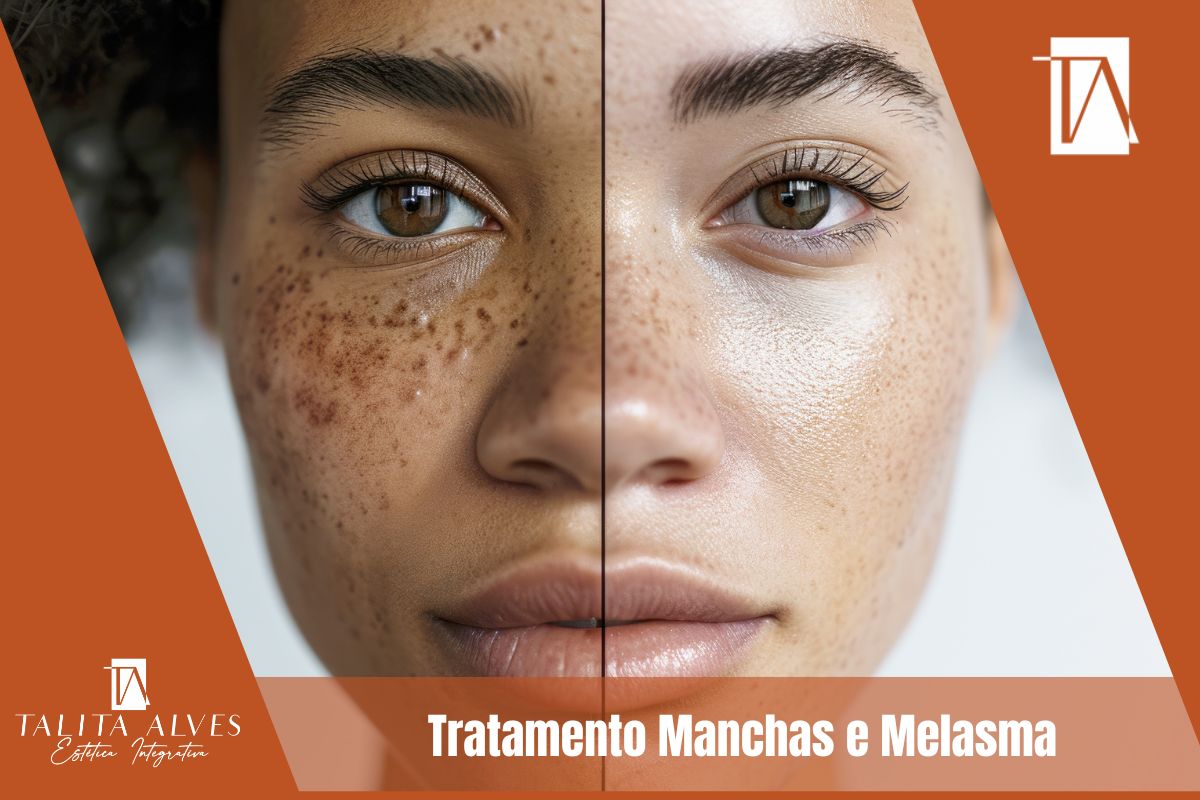 Tratamento Manchas e Melasma ao Lado do Metrô São Judas