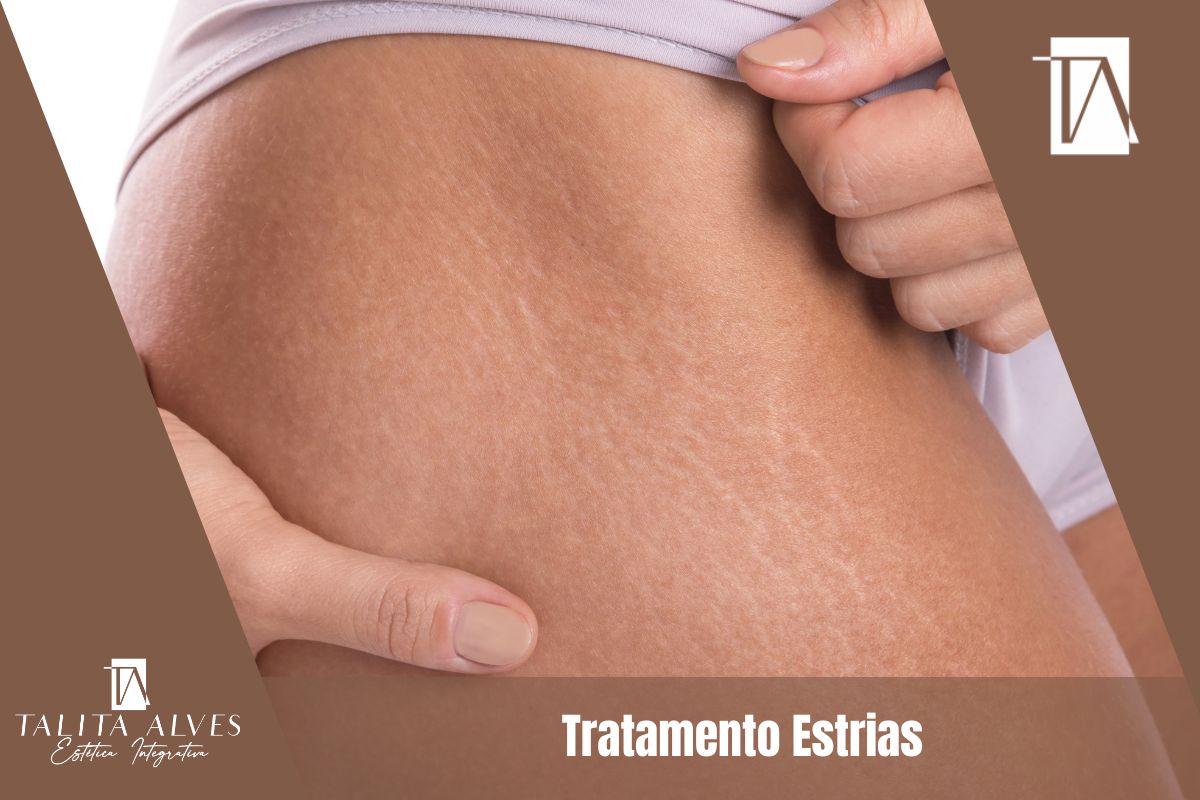 Clinica de Estética Corporal Tratamento Estrias