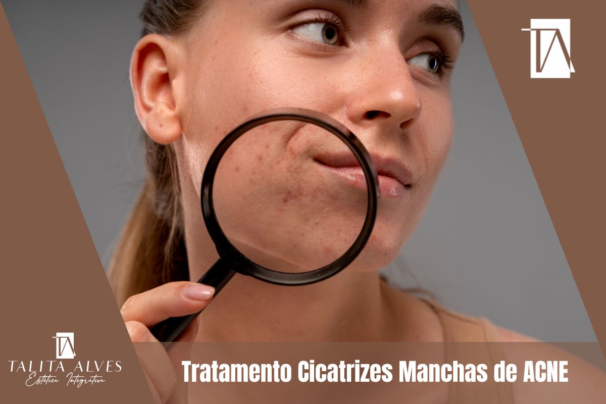 Clinica de Estética Facial Tratamento Cicatrizes Manchas de ACNE