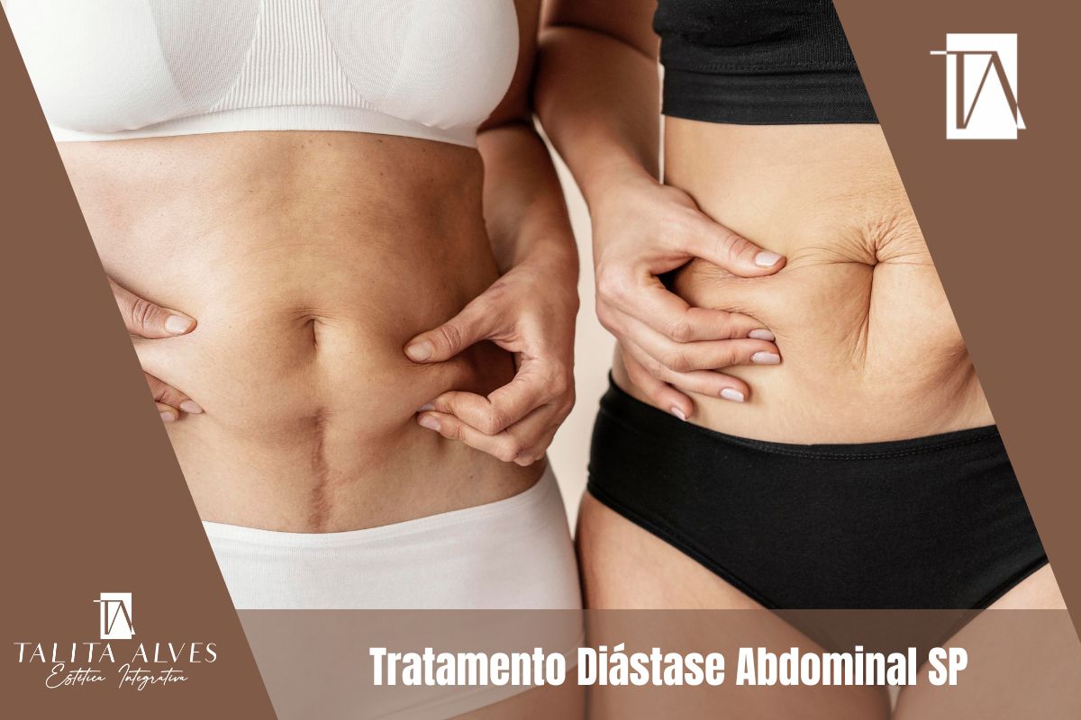 Tratamento Diástase Abdominal SP
