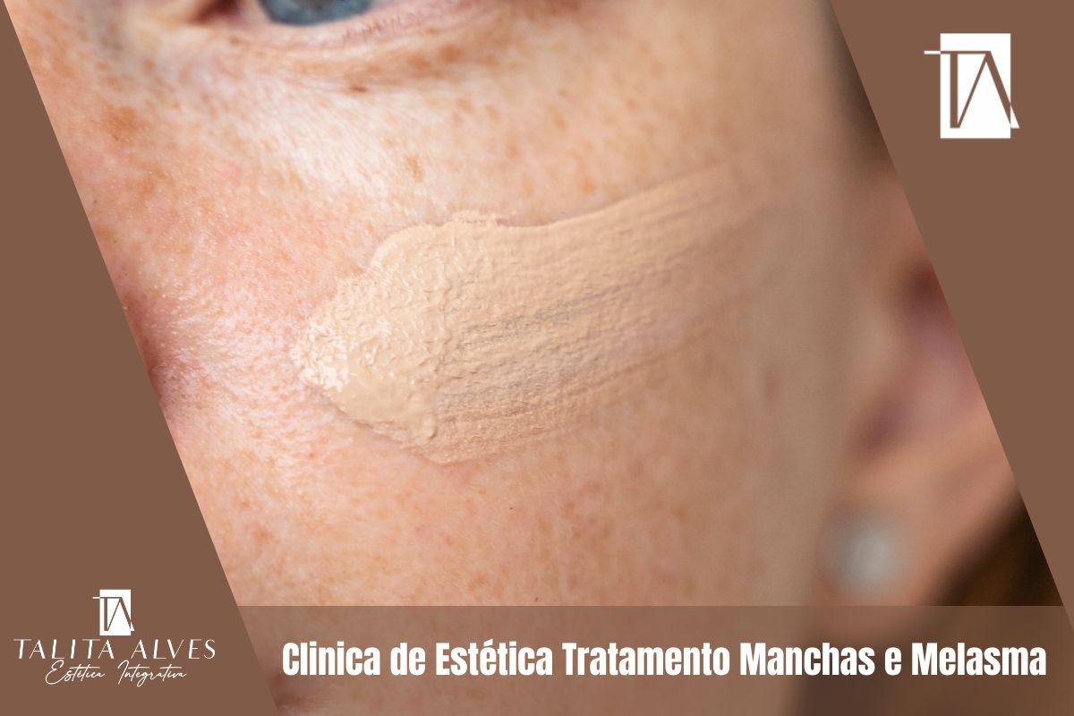 Clinica de Estética Tratamento Manchas e Melasma