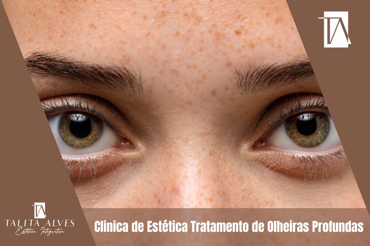 Clinica de Estética Tratamento de Olheiras Profundas