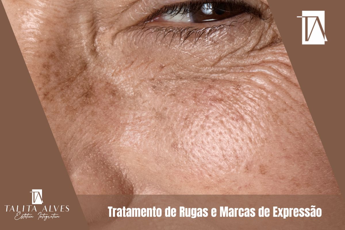 Clinica de Estética Tratamento de Rugas e Marcas de Expressão