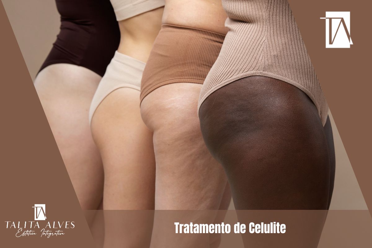 Tratamento de Celulite