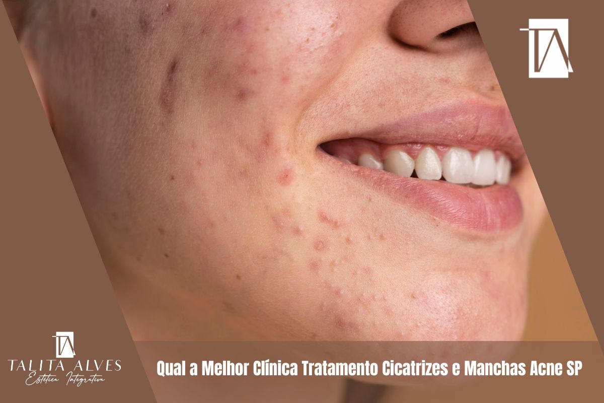Qual a Melhor Clínica Tratamento Cicatrizes e Manchas Acne SP