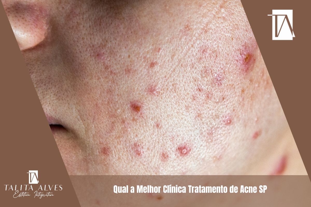 Qual a Melhor Clínica Tratamento de Acne SP