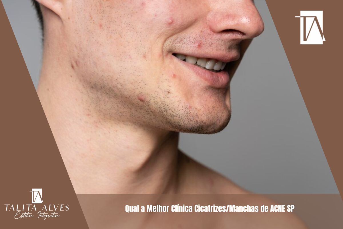 Qual a Melhor Clínica Cicatrizes/Manchas de ACNE SP
