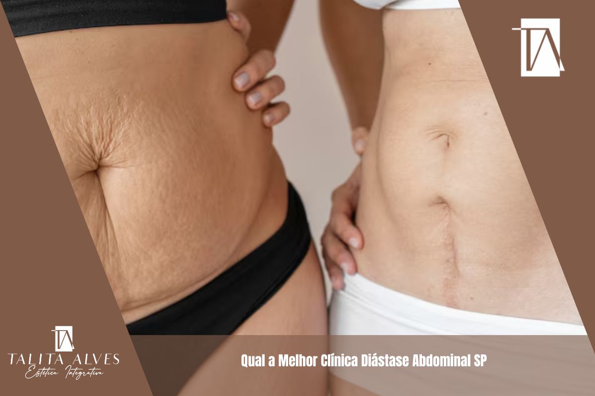 Qual a Melhor Clínica Diástase Abdominal SP