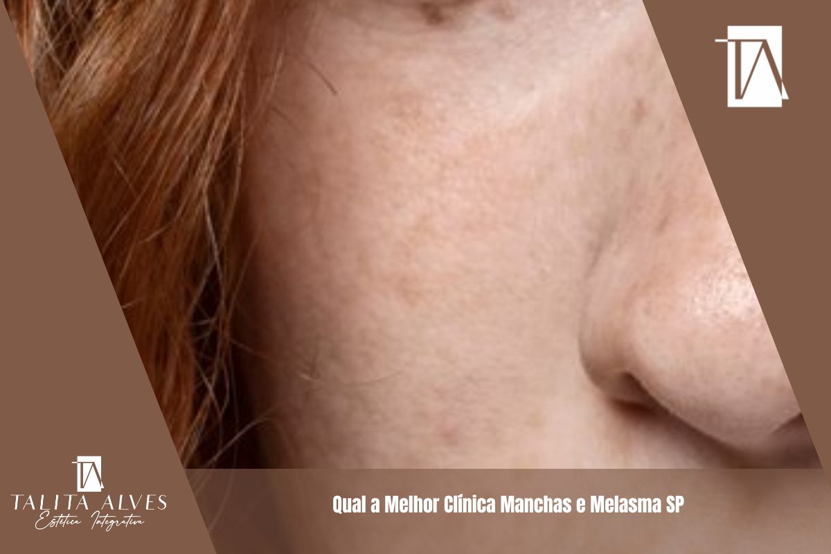 Qual a Melhor Clínica Manchas e Melasma SP