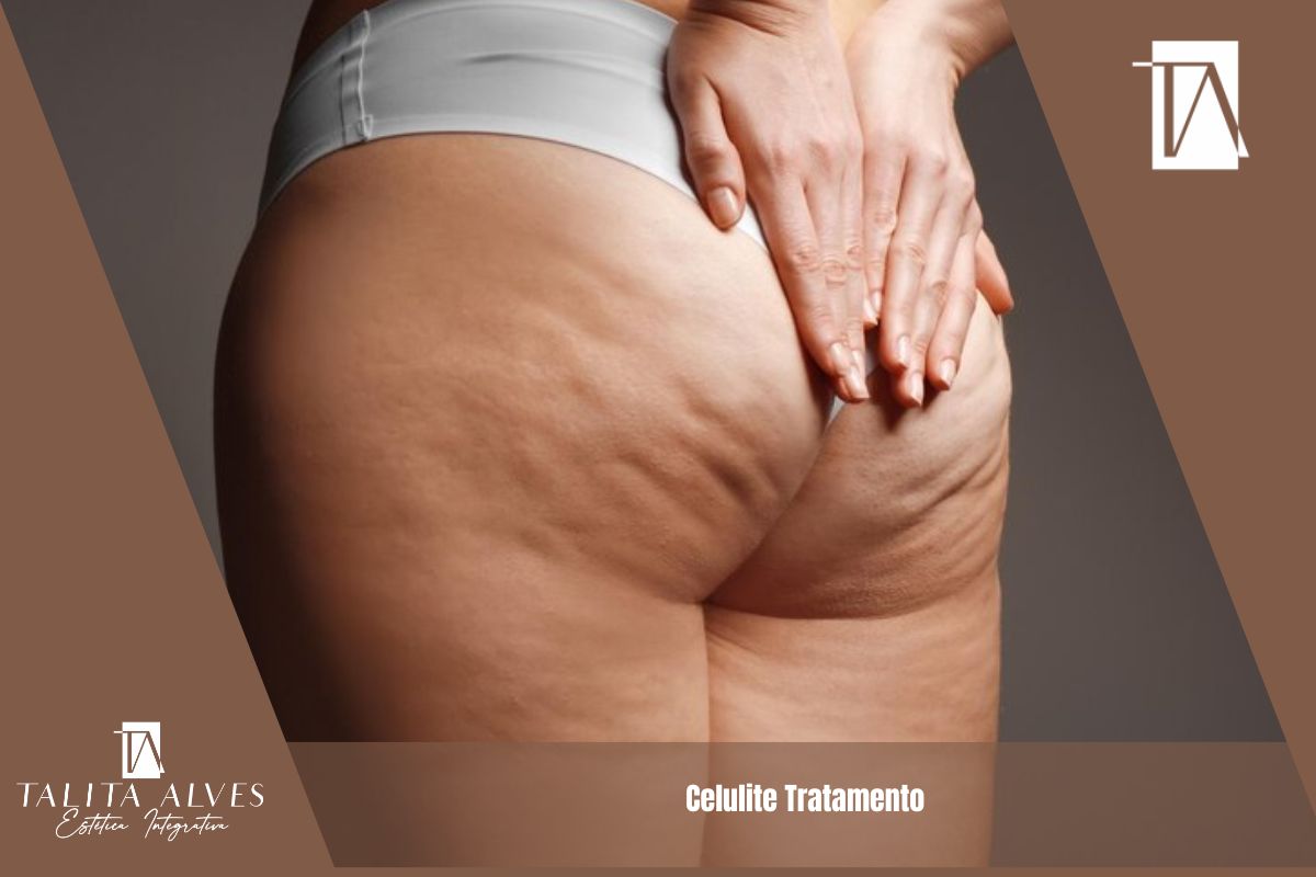 Celulite Tratamento