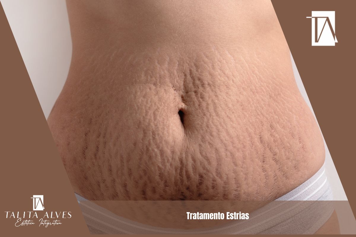 Tratamento Estrias