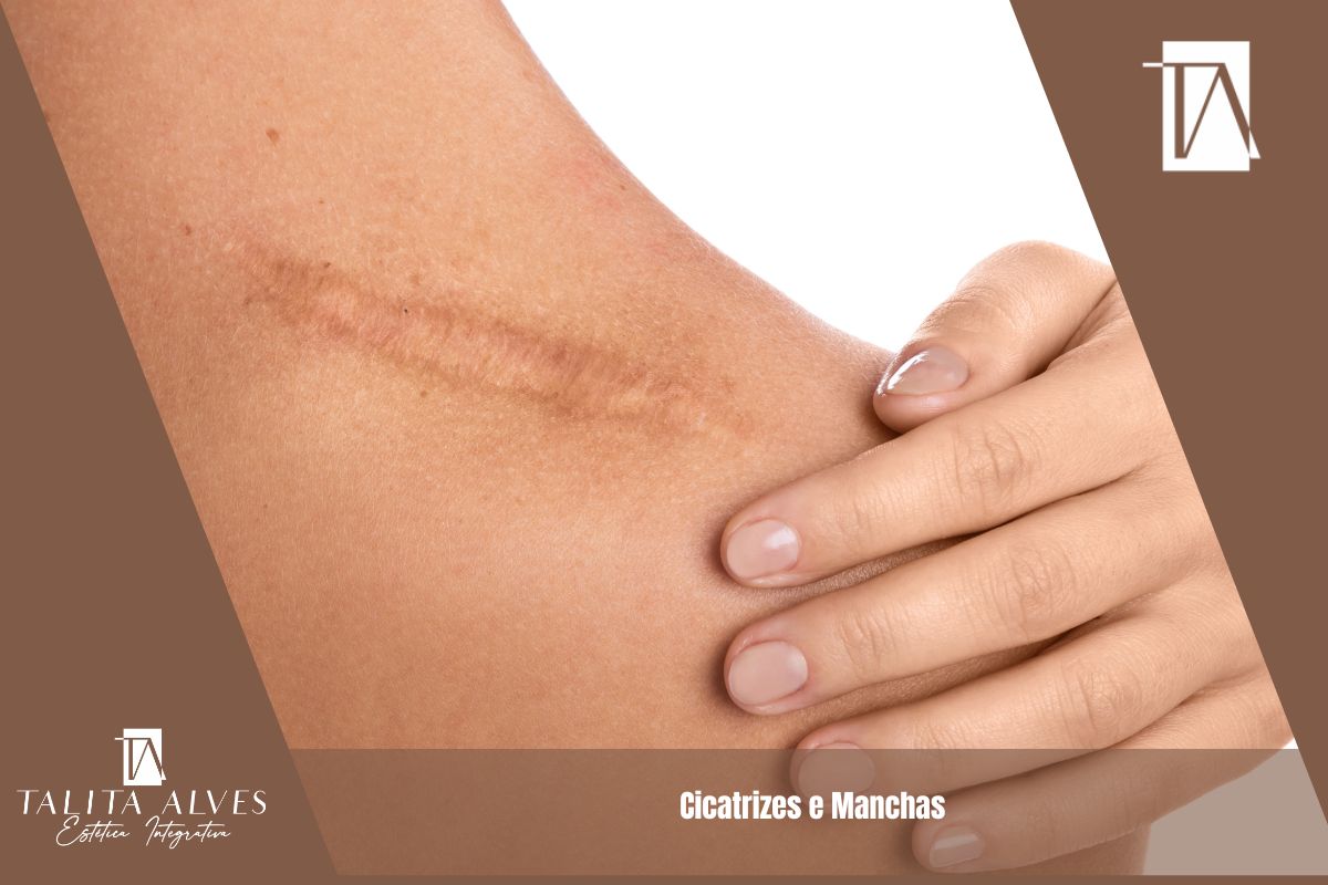 Cicatrizes e Manchas