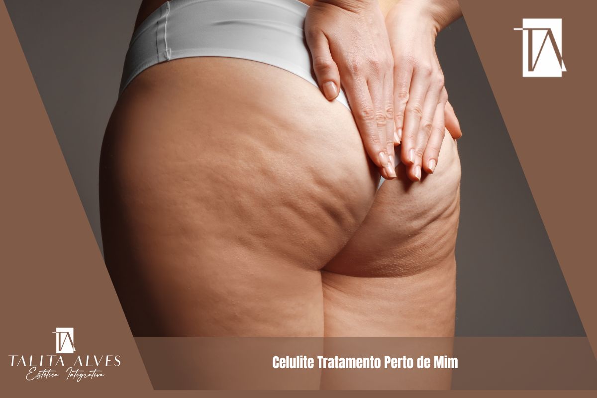 Celulite Tratamento Perto de Mim