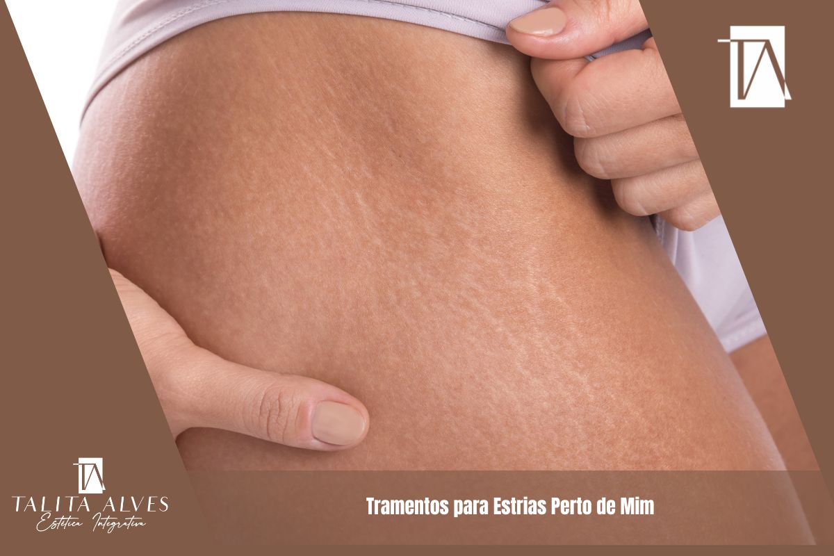 Tramentos para Estrias Perto de Mim