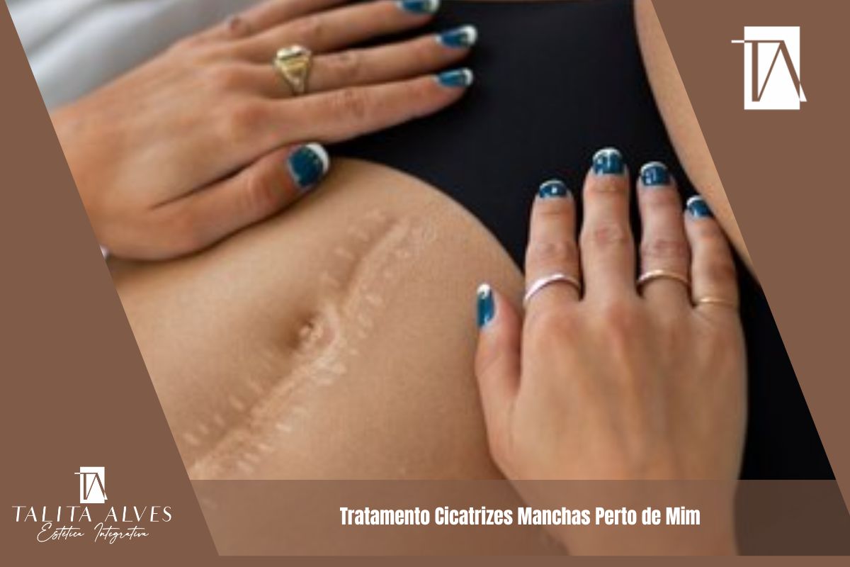 Tratamento Cicatrizes Manchas Perto de Mim