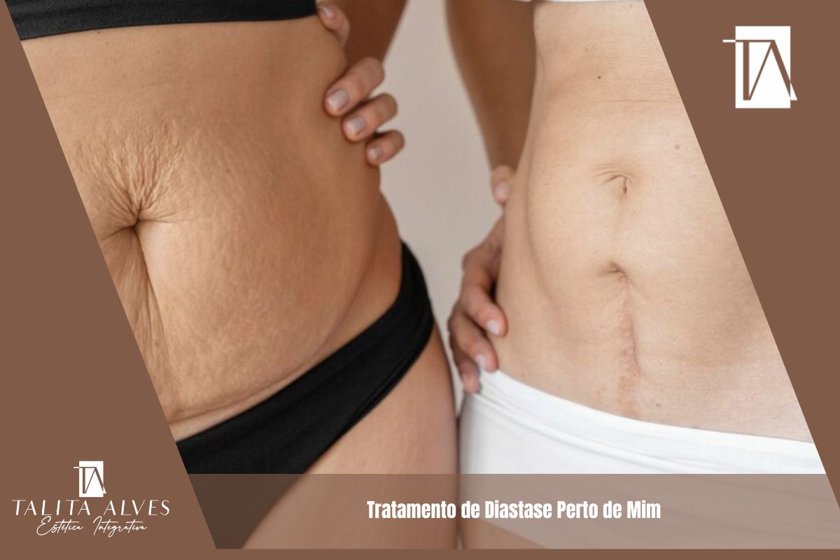 Tratamento de Diastase Perto de Mim