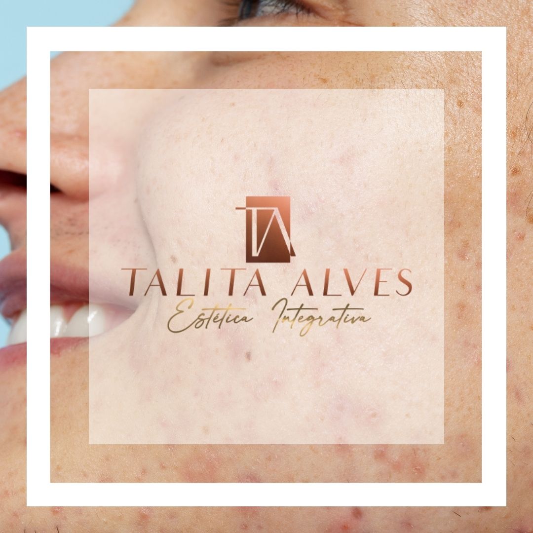 Tratamento Manchas de Acne ao Lado do Metrô São Judas