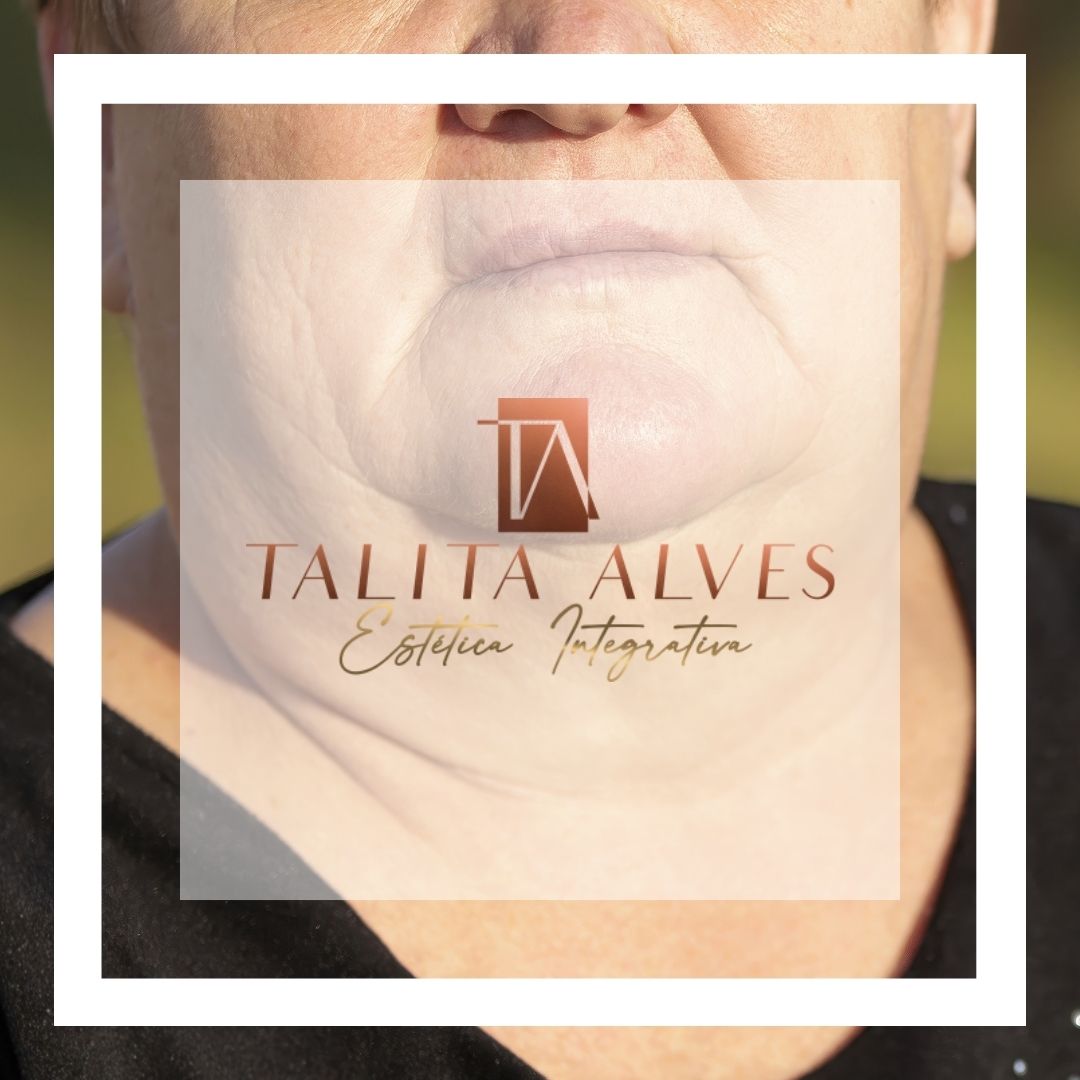 Clinica de Estética Facial Eliminar ou Diminuir Papadada