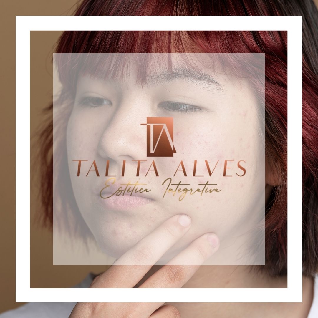 Clinica de Estética Cicatrizes Manchas de ACNE