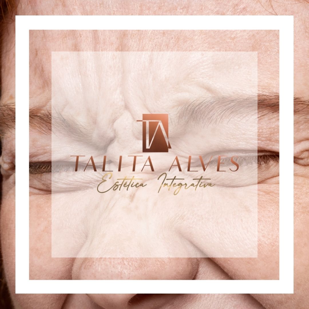 Clinica de Estética Tratamento de Rugas e Marcas de Expressão