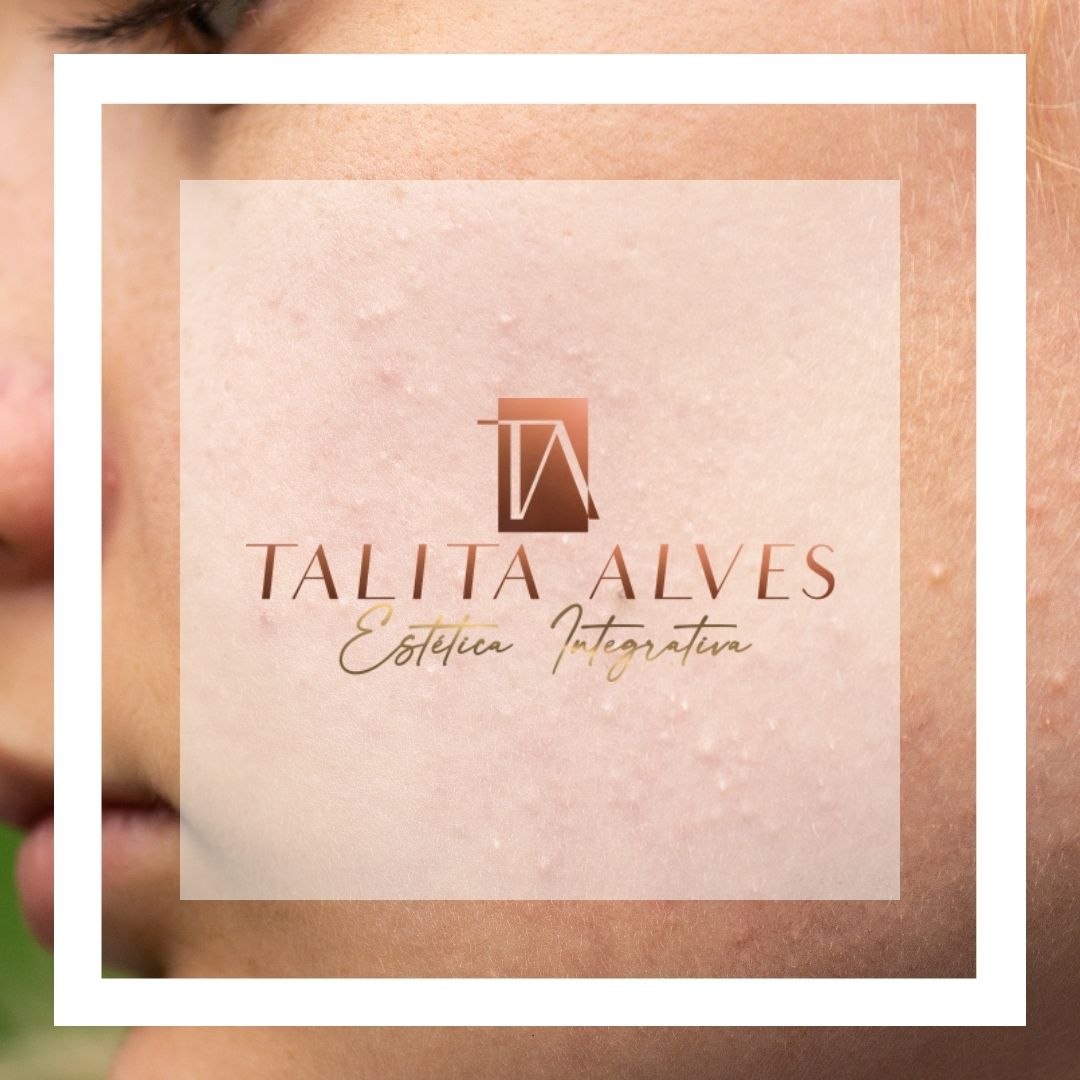 Qual a Melhor Clínica Tratamento de Acne SP