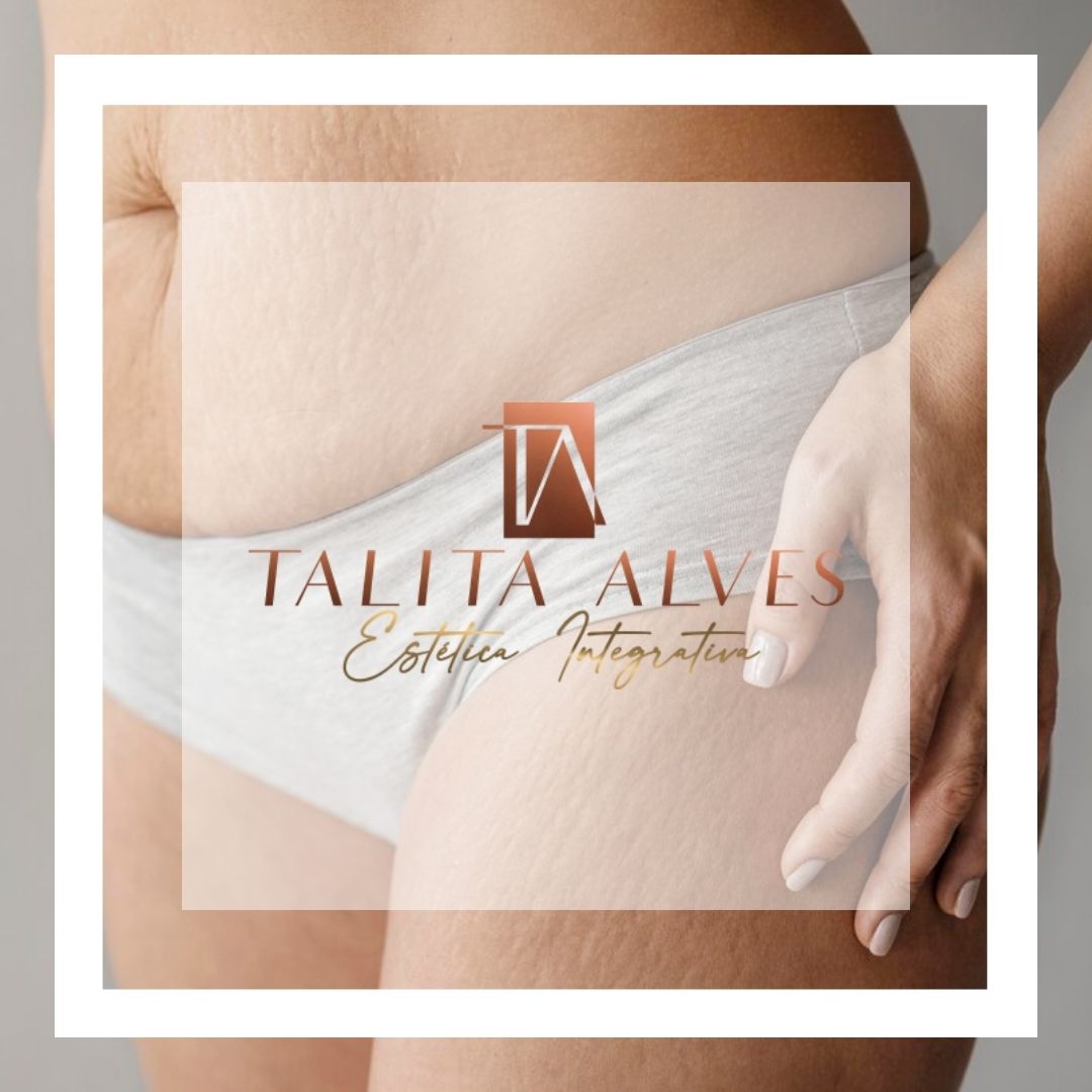 Tramentos para Estrias Perto de Mim