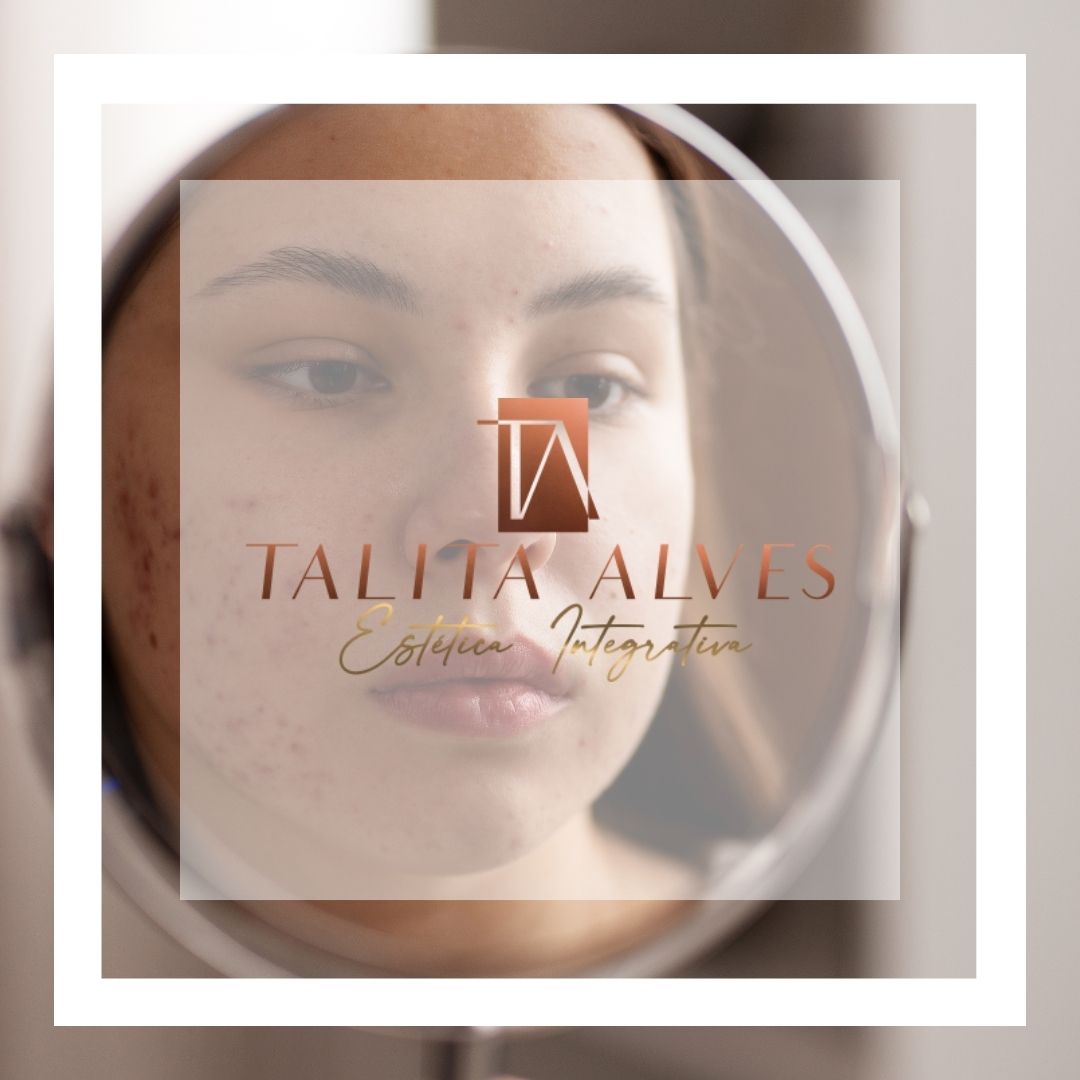 Cicatrizes e Manchas da Acne Perto de Mim