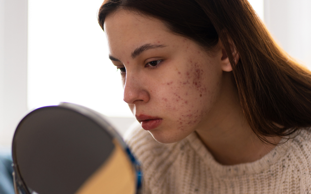 Cicatrizes de Acne Clínica Talita Alves