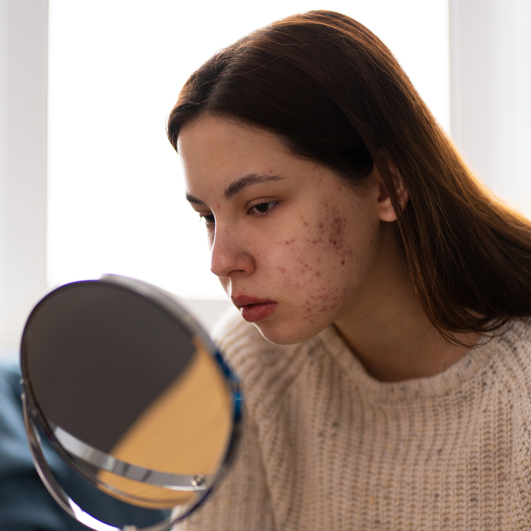 Cicatrizes de Acne Clínica Talita Alves