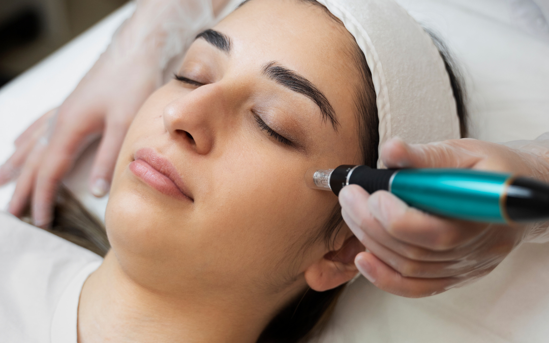 Peeling de Diamante Clínica Talita Alves